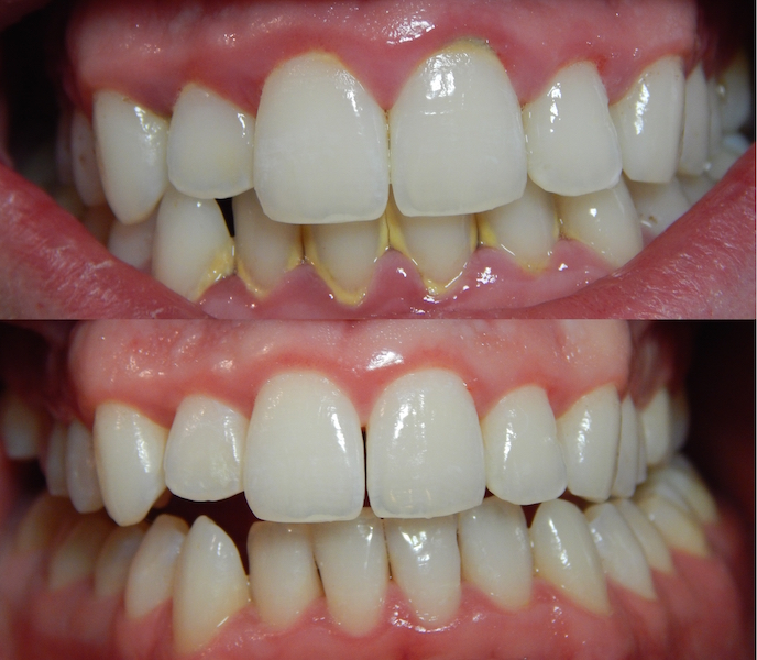Gingivitis before and after 3